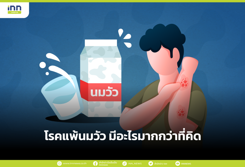 โรคแพ้นมวัว