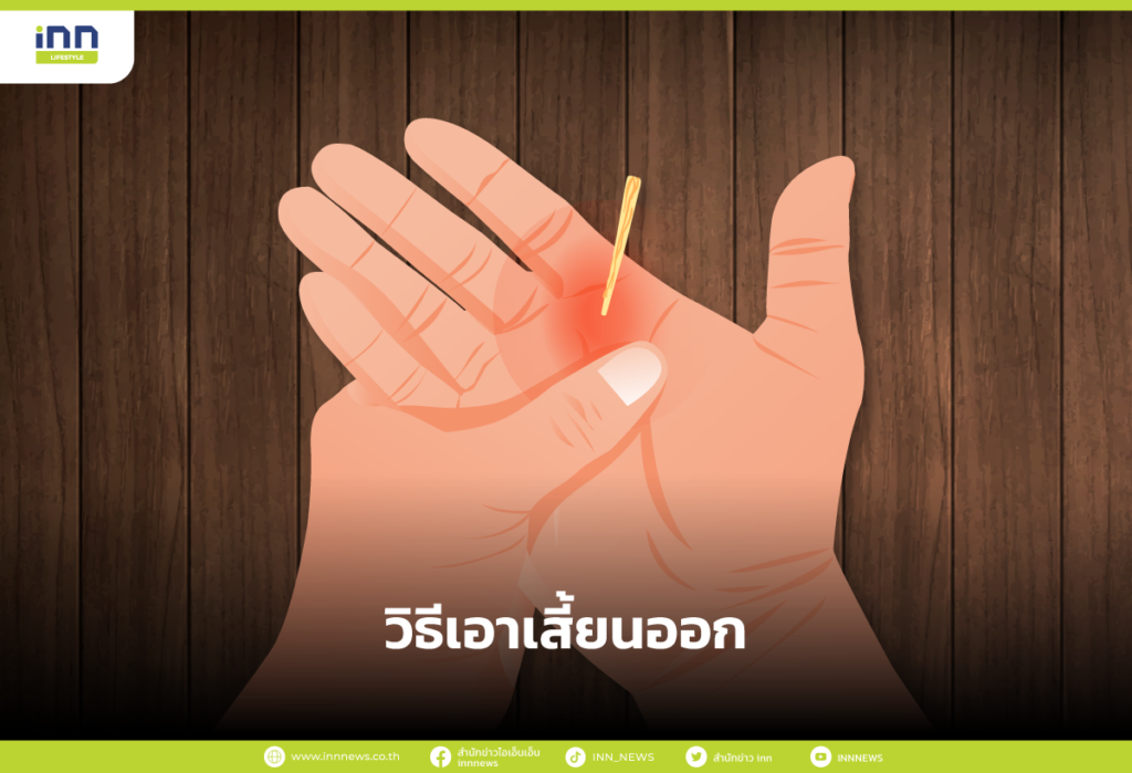 วิธีเอาเสี้ยนออก