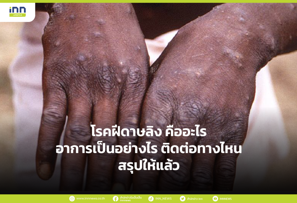 โรคฝีดาษลิง คืออะไร