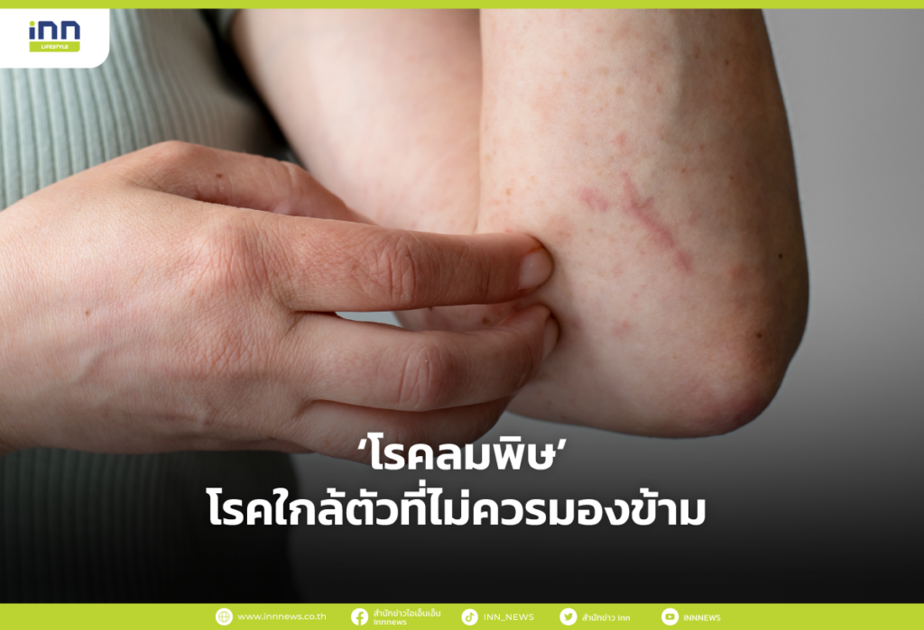 โรคลมพิษ