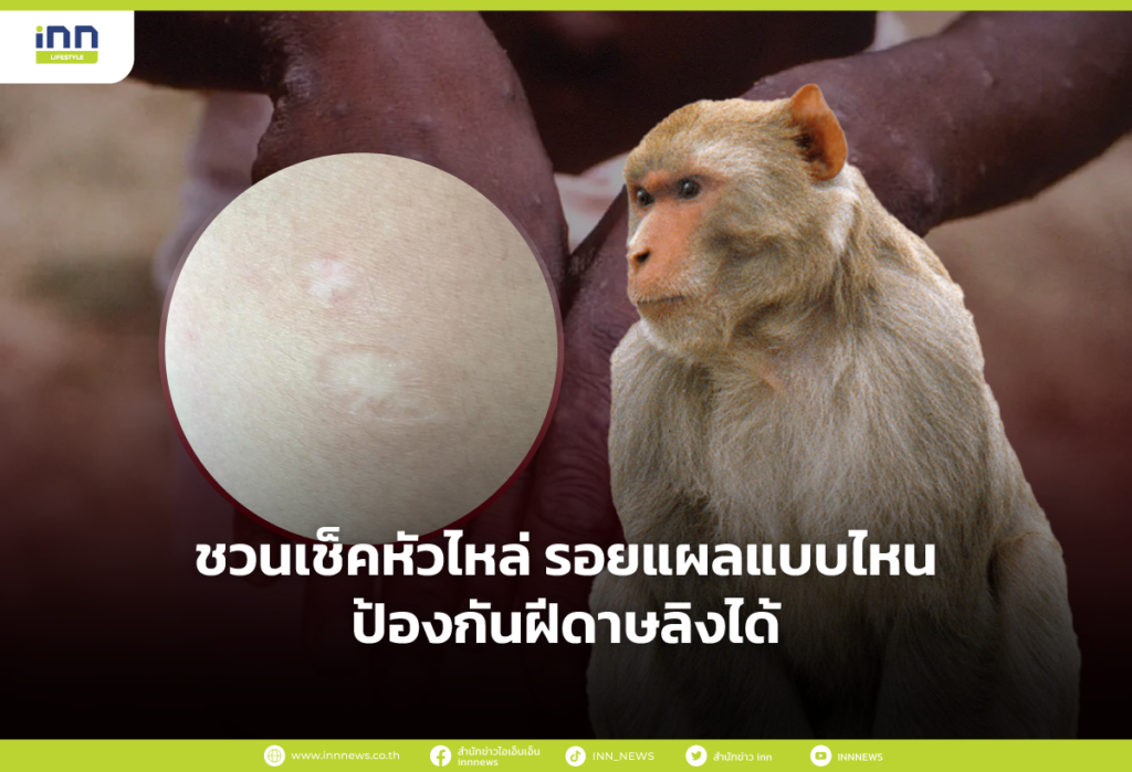 ชวนเช็คหัวไหล่ รอยแผลแบบไหนป้องกันฝีดาษลิงได้