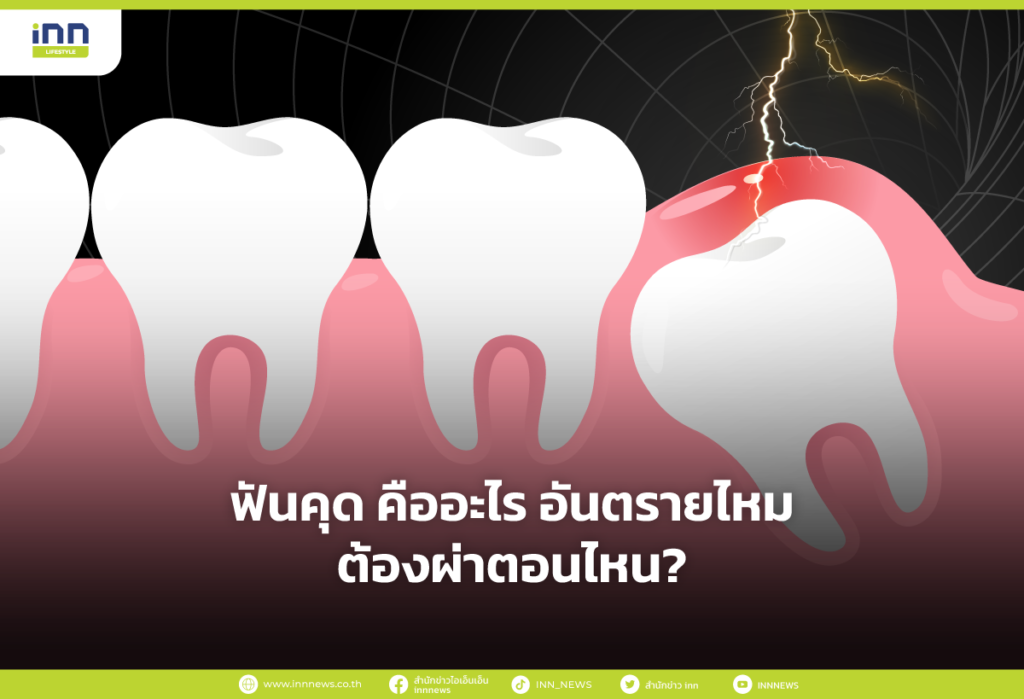 ฟันคุด คืออะไร