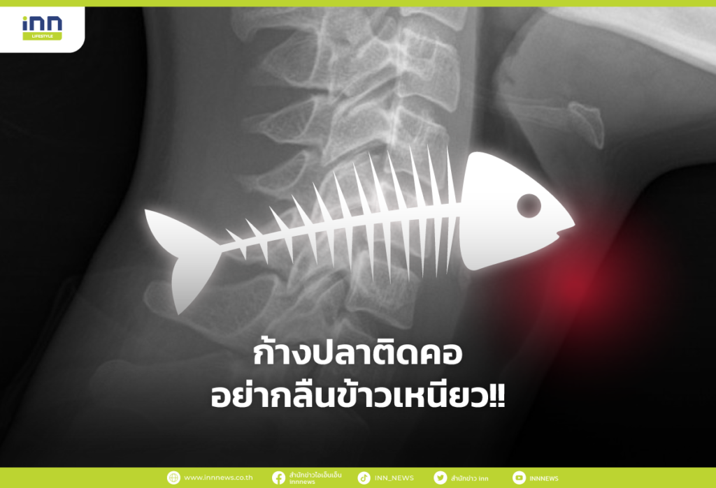 ก้างปลาติดคอ