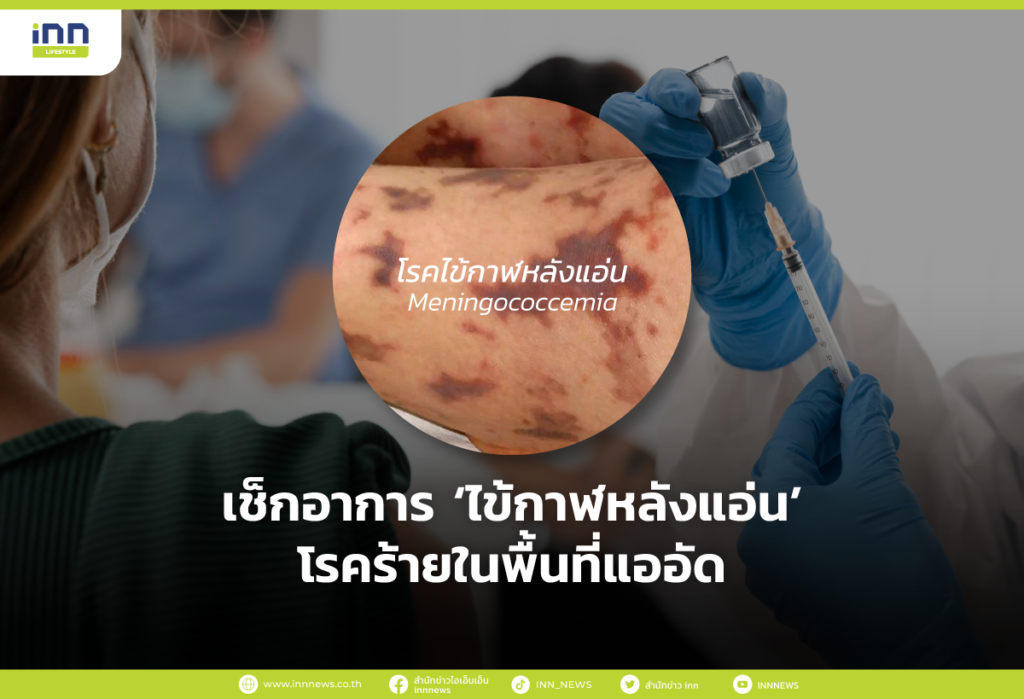 เช็กอาการ ‘ไข้กาฬหลังแอ่น’ โรคร้ายในพื้นที่แออัด