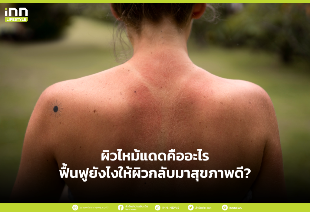ผิวไหม้แดดคืออะไร ฟื้นฟูยังไงให้ผิวกลับมาสุขภาพดี?