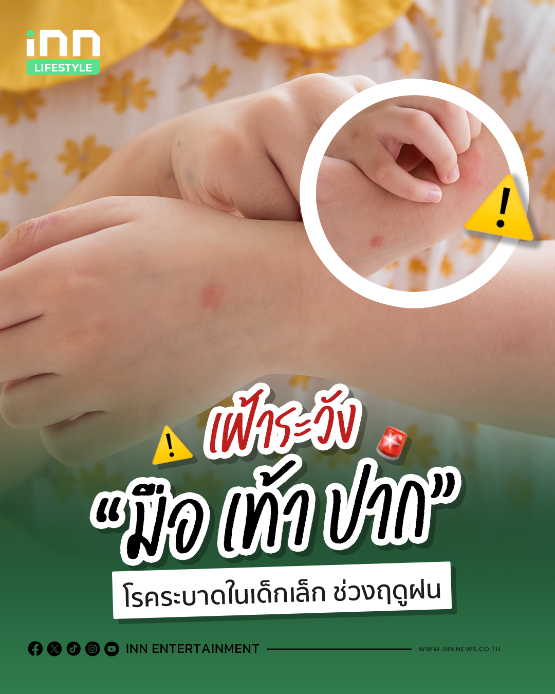 โรคมือ เท้า ปาก